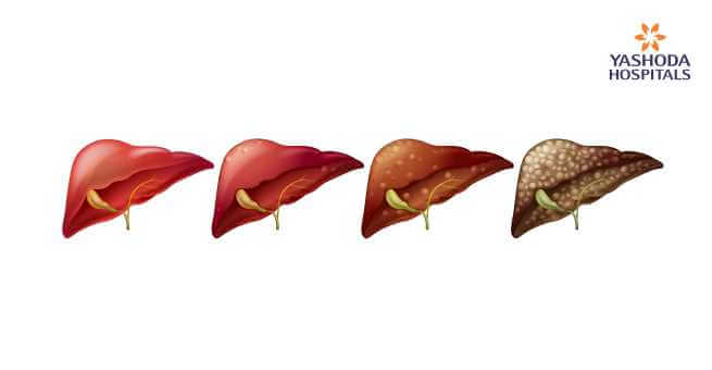 Stages of Liver Cancer