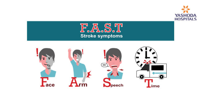 Stroke Symptoms in Men and Women