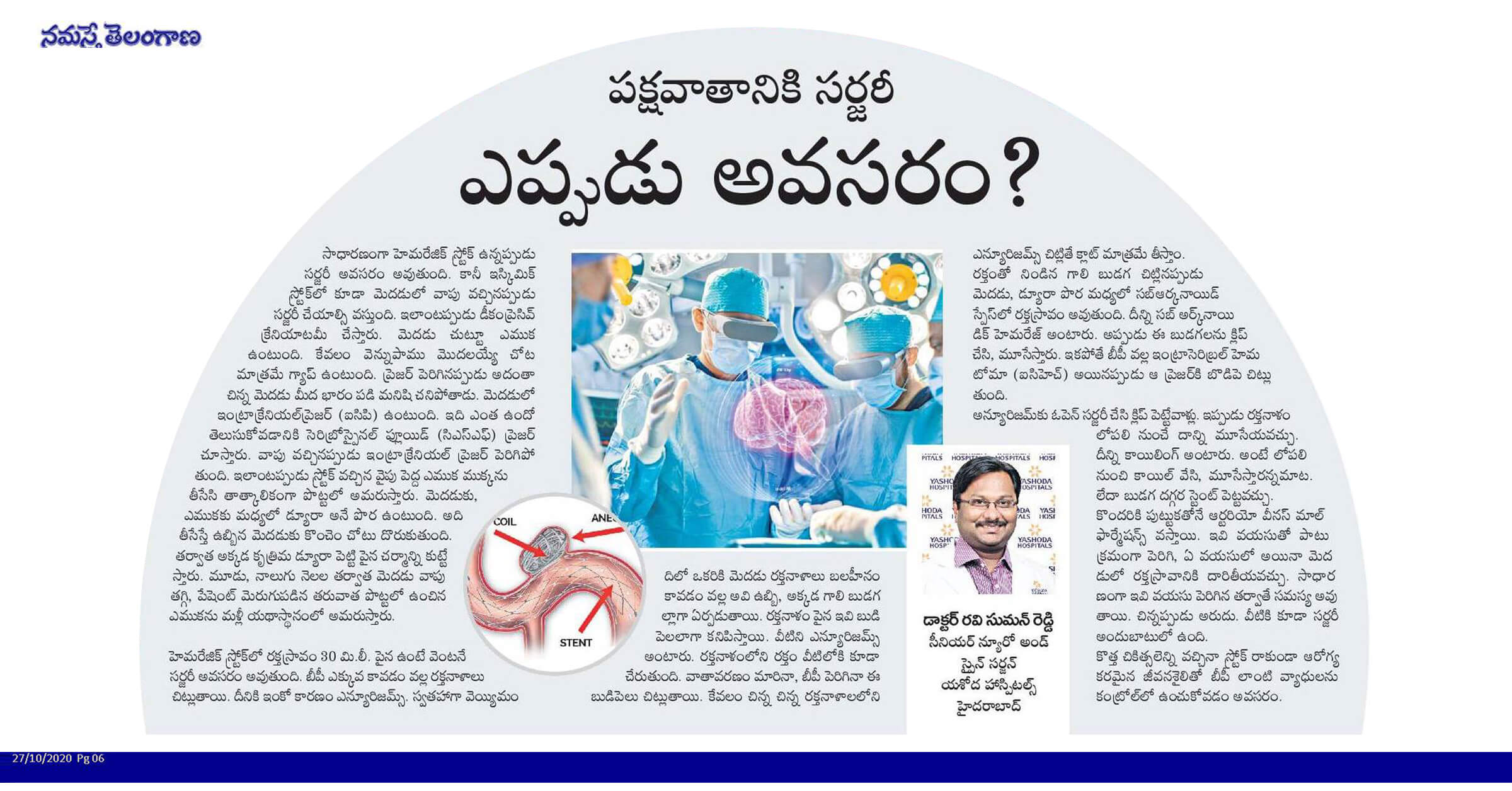 Surgical Treatment for Stroke Paralysis Dr Ravi Suman Reddy Neuro & Spine Surgeon
