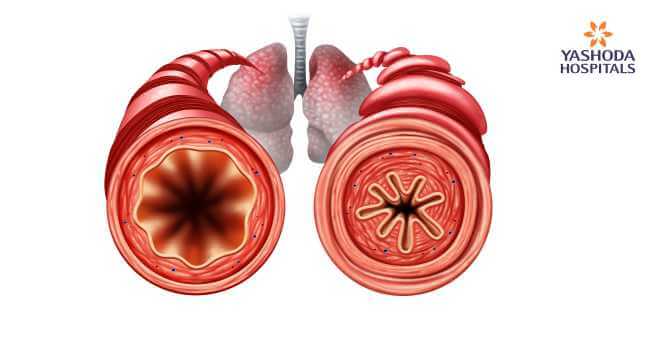 Treatment of severe Asthma