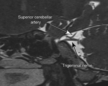 Trigeminal Nerve
