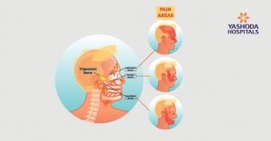 Radiofrequency Ablation for Trigeminal Neuralgia - Yashoda Hospital