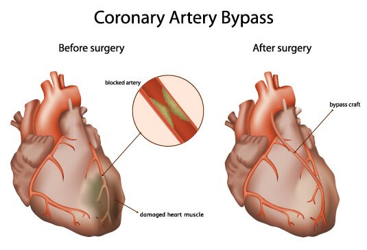 Coronary Artery Bypass Grafting  Cost in Hyderabad
