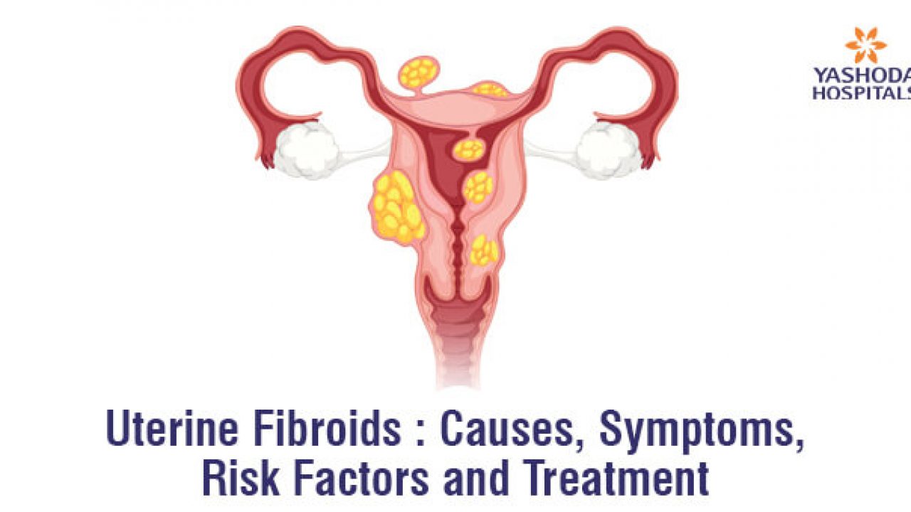 Uterine Fibroids Causes
