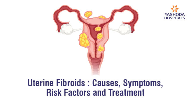Uterine Fibroids : Causes, Symptoms, Risk Factors and Treatment