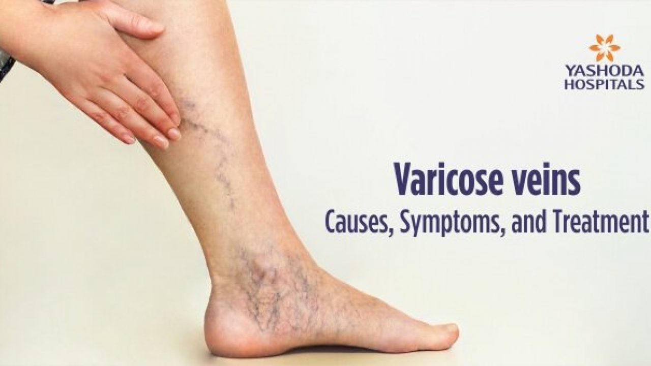 Will my varicose veins come back after treatment by Rajiv Nagesetty - BASS  Vein Center