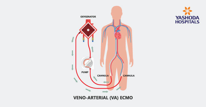 Venoarterial (VA) ECMO