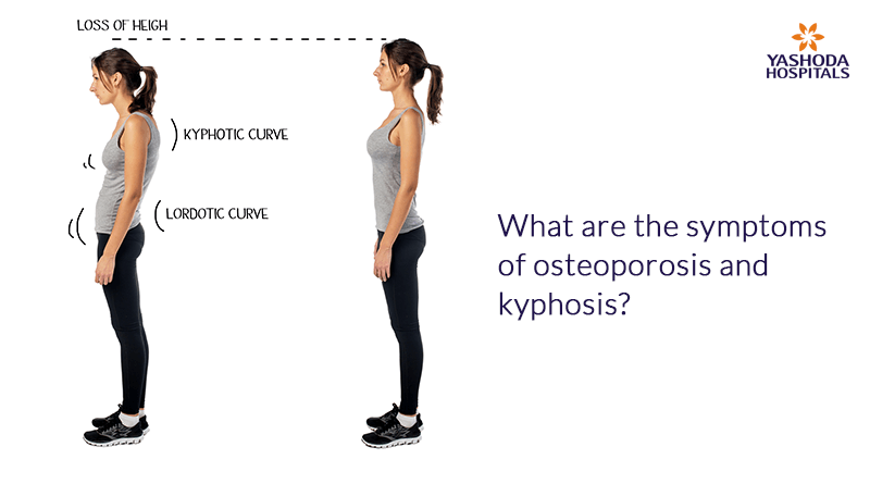What are the symptoms of osteoporosis & kyphosis