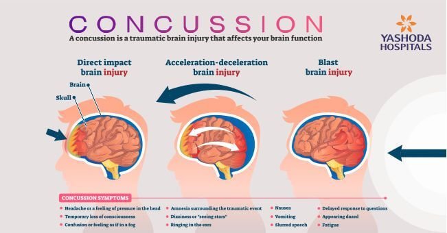 What causes a concussion