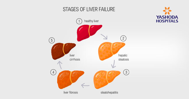 What is Acute Liver Failure?