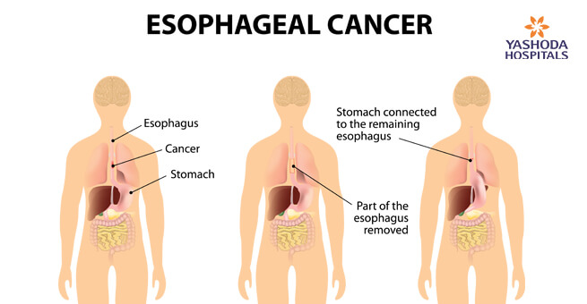 What is Esophageal Cancer