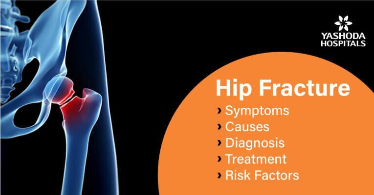 Hip Fracture: symptoms, causes, diagnosis, treatment, risk factors
