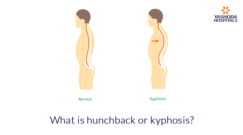 What is hunchback or kyphosis