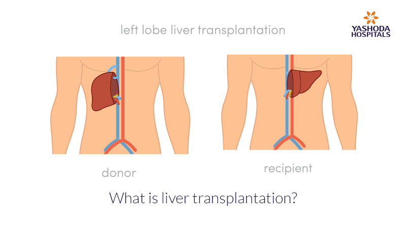 What is liver transplantation