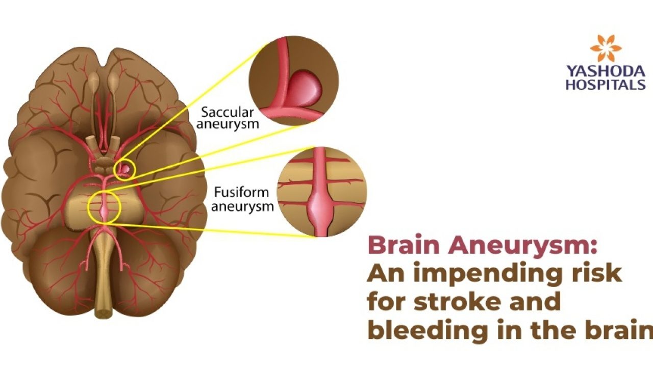 Brain Aneurysm An Impending Risk For Stroke And Bleeding In Brain