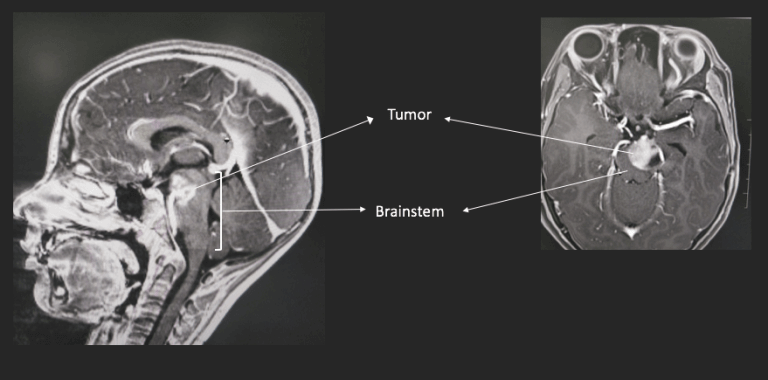 brain mri scan