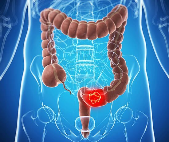 colon cancer or colorectal cancer