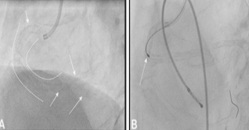Panel A: The curved dashed lines across the entire course of the right coronary artery depicting the presence of the calcium, which posed difficulty in crossing the artery. Panel B : the use of Rotablation for debulking the calcium from the lesion. The Rota burr is seen crossing the vessel under the presence of temporary pacemaker wire as a stand by if patient develops heart blocks leading to low heart rate