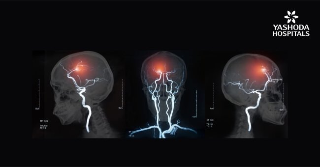 diagnose a stroke