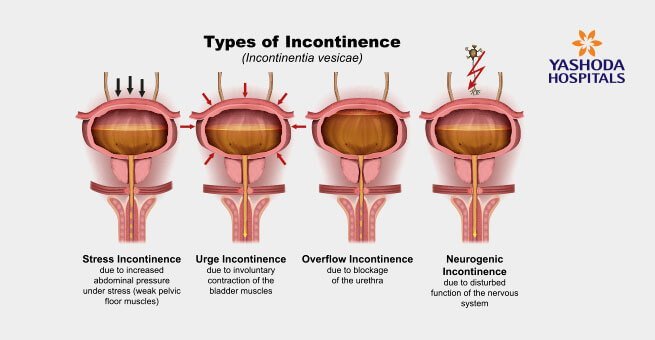 different types of urinary incontinence different types of urinary incontinence
