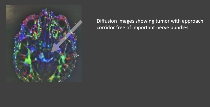 diffusion tensor imaging- special mri