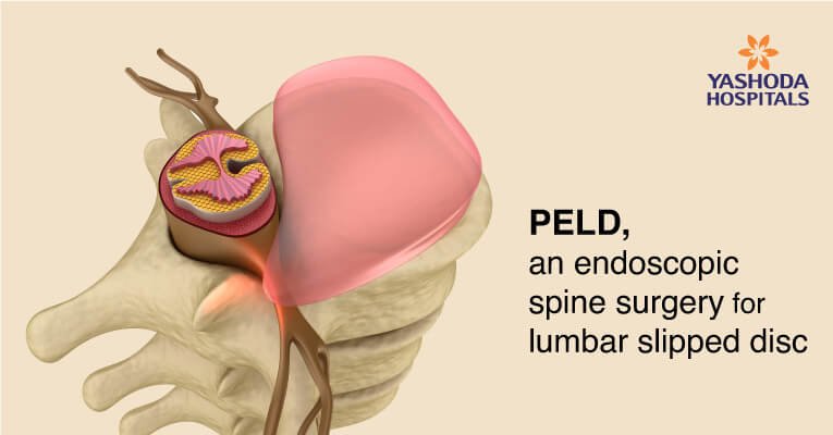 endoscopic spine surgery for slipped disc-PELD