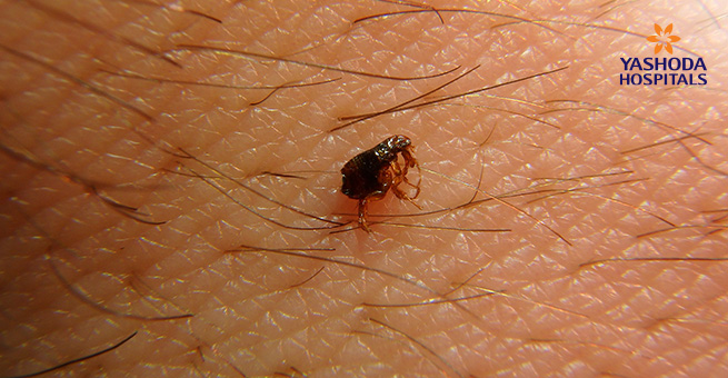 Flea Bite: Symptoms, Risks And Treatment