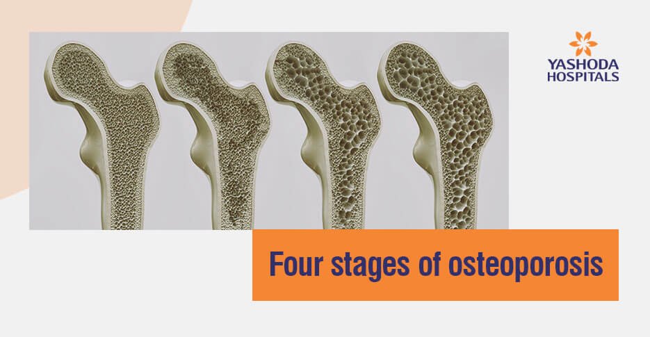 can osteoporosis become osteopenia