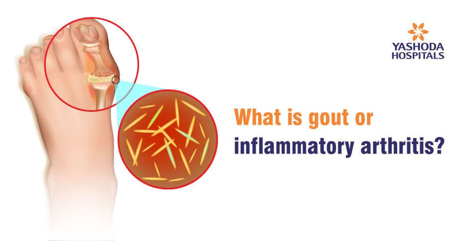gout or inflammatory arthritis