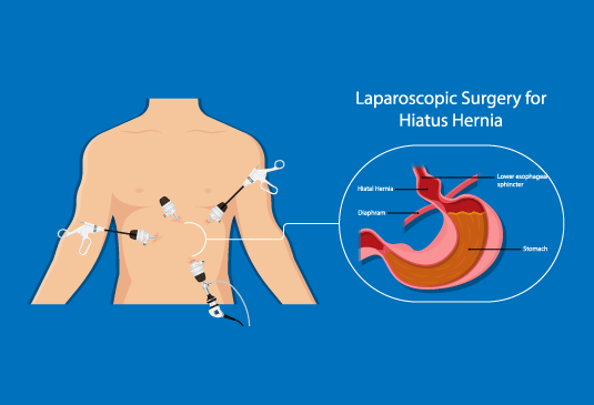 cost of Hernia Surgery in India