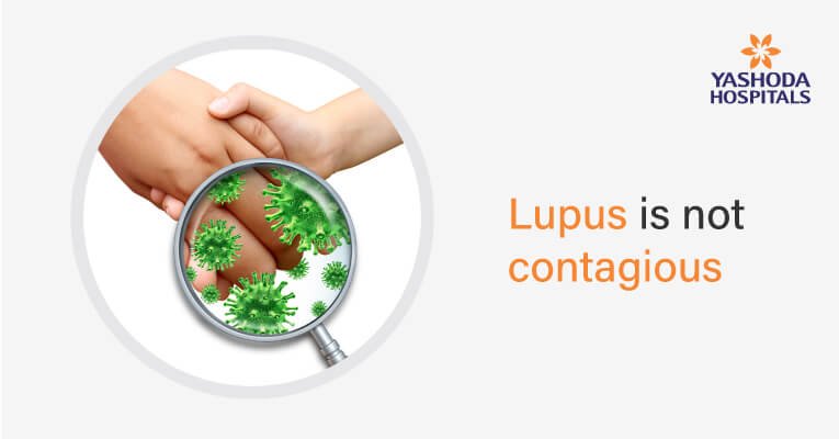 the most frequently asked questions about lupus
