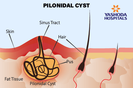 pilonidal cyst