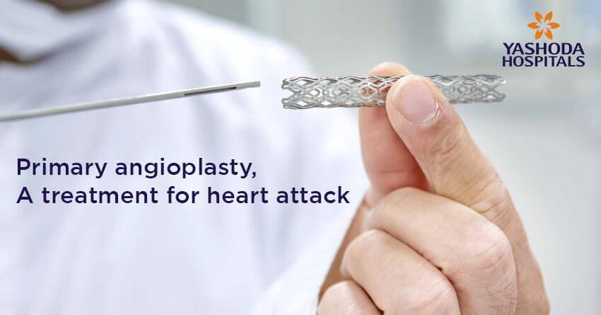 Primary angioplasty for Acute Myocardial infarction