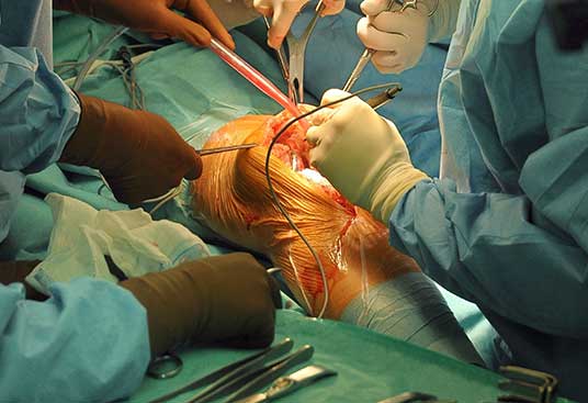 Types of procedures for knee replacement