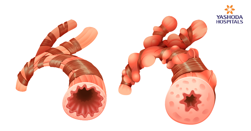 What is the relationship between restrictive lung diseases & tuberculosis