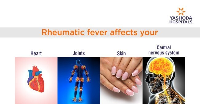 rheumatic fever affects