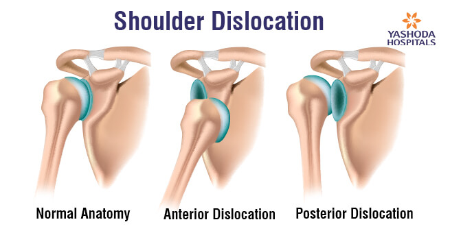 shoulder-dislocation1