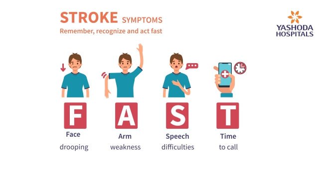 signs and symptoms of a stroke