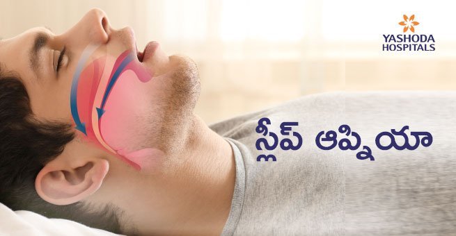 sleep apnea