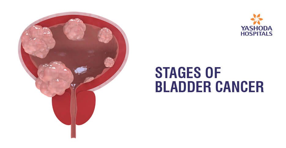Stages Of Bladder Cancer In Men