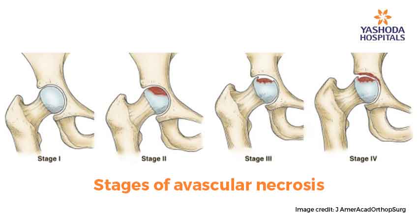 Avascular Necrosis Stages