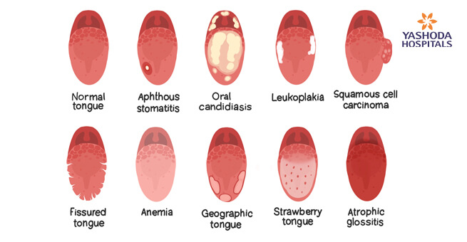 symptoms of tongue cancer