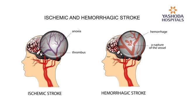 the types of stroke