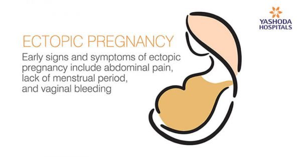 Early signs and symptoms of ectopic pregnancy | ectopic pregnancy ...