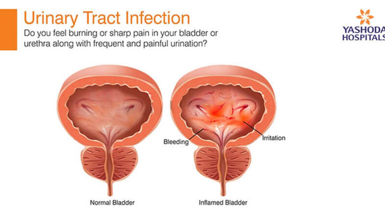 urinery tract infection